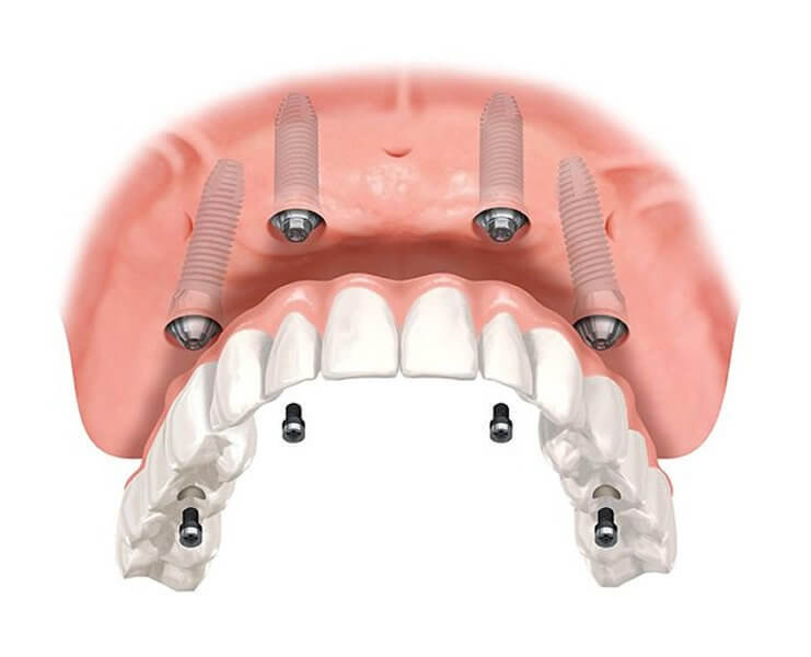 после коронки можно восстановить зуб дантистофф
