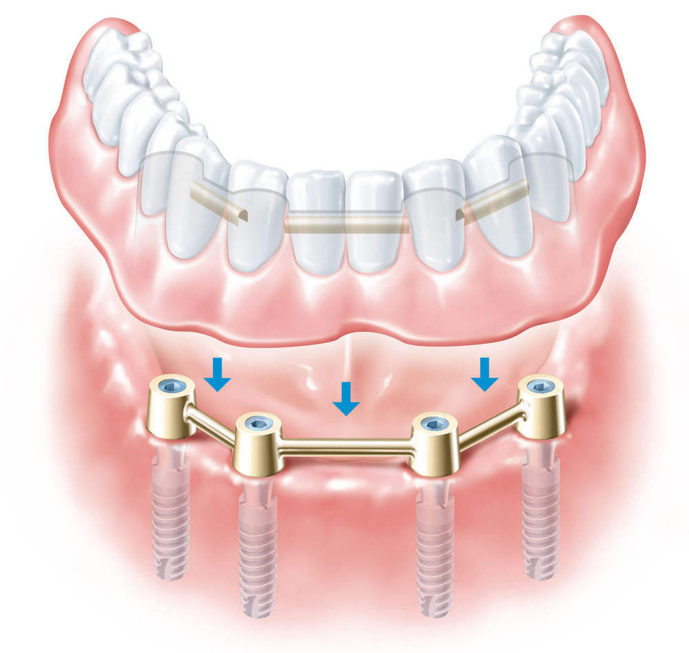 Нужно ли ухаживать за имплантами – советы стоматологов