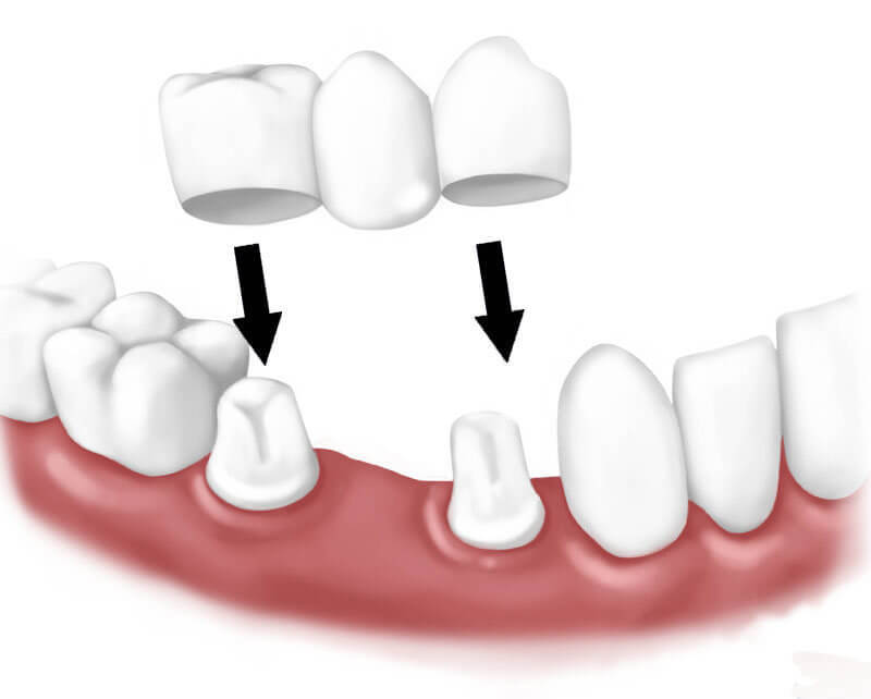Альтернативные варианты вставить зуб после удаления