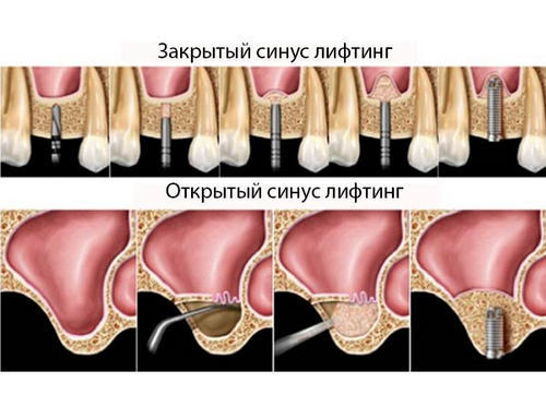 Костная ткань зуба фото