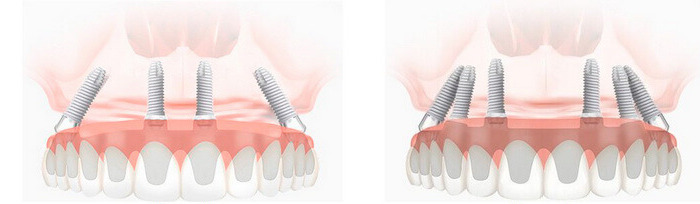 Методы комплексной имплантации при полном отсутствии зубов