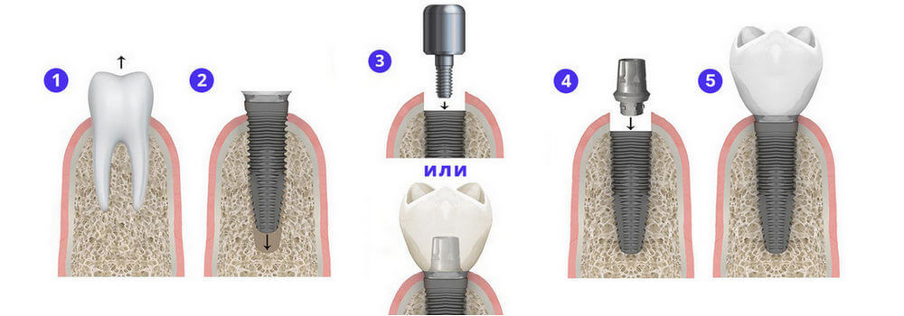 Одномоментная имплантация сразу после удаления зуба