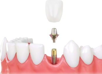 Что делать, если нужно поставить несколько имплантов или сразу целый зубной ряд?