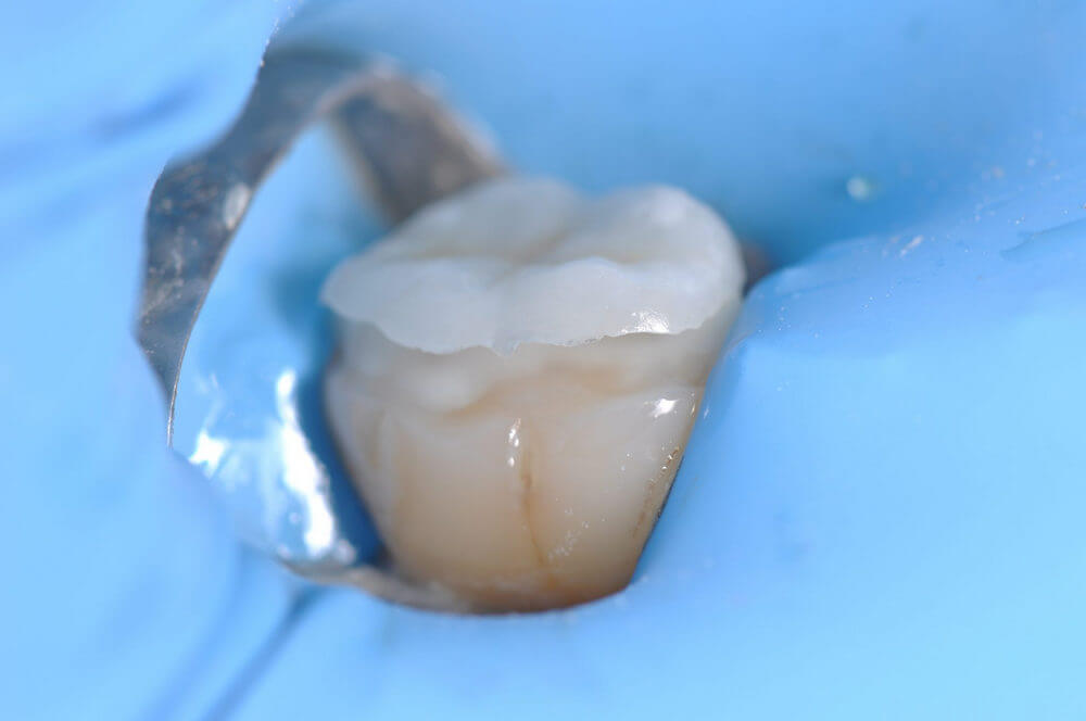 Реставрация зуба вкладкой