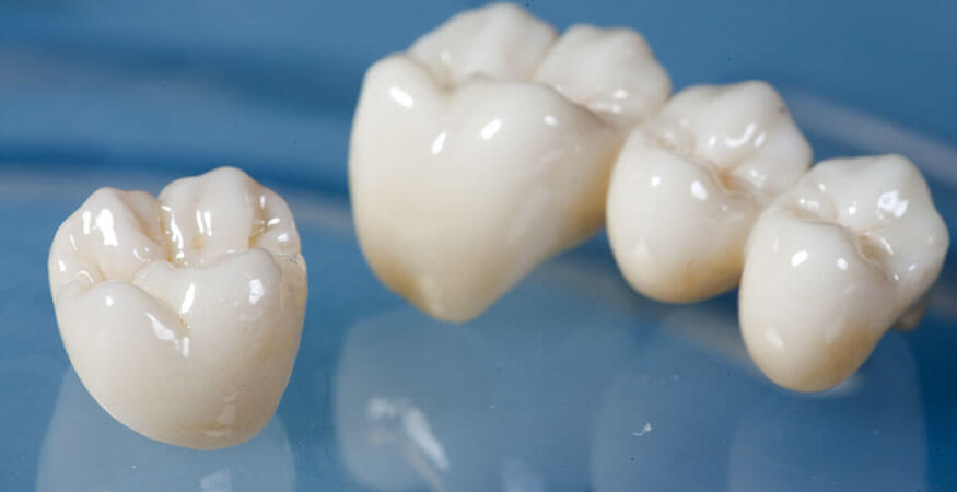 Реставрация зуба коронкой