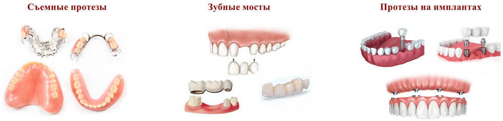 Способы протезирования при отсутствии зубов