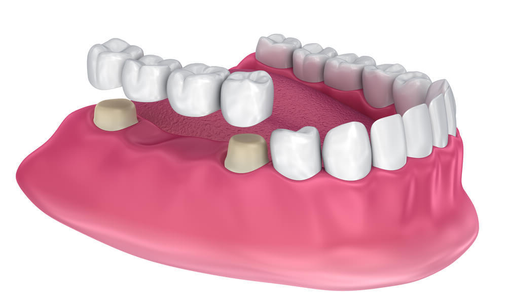 Мостовидный зубной протез на два зуба