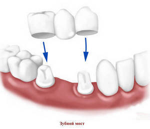 какое существует протезирование зубов дантистофф