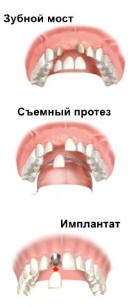 Протезы при отсутствии зубов после удаления