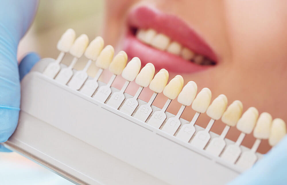 Подбор цвета зубов в стоматологии