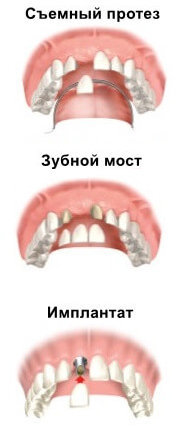 Виды зубных протезов при утрате одного зуба