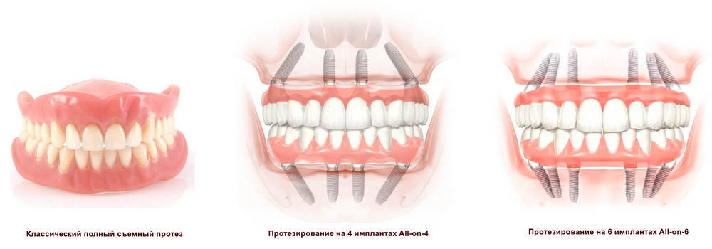 Протезирование при полном отсутствии зубов верхней челюсти