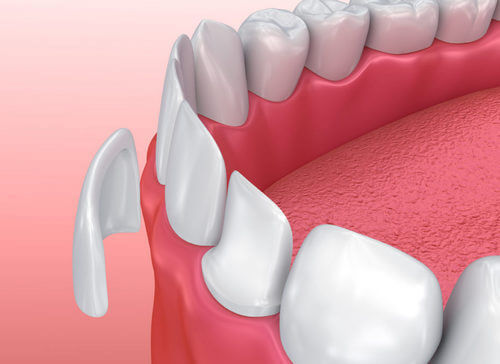 Протезирование нижних зубов при дефектах эмали