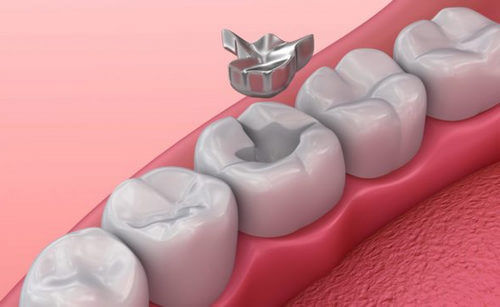 Протезирование нижних зубов при разрушениях менее 50%