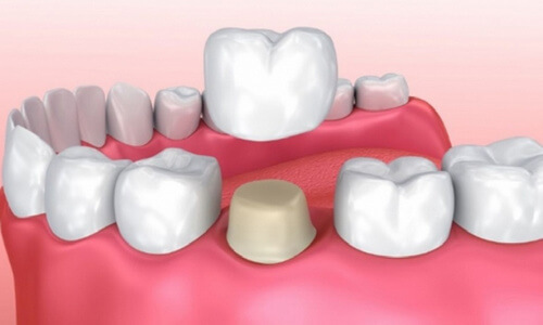 Протезирование нижних зубов при разрушениях более 50%