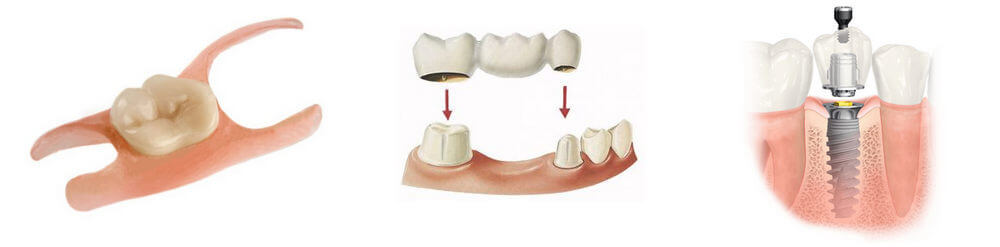 Протезирование при частичном отсутствии нижних зубов