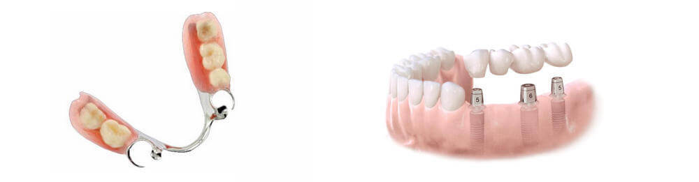 Протезирование при отсутствии нескольких нижних зубов