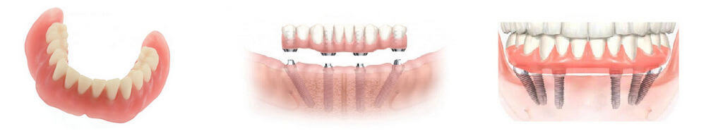 Протезирование при полном отсутствии зубов нижней челюсти