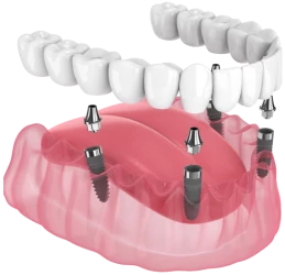 Восстановление всех зубов на 4 имплантах Osstem