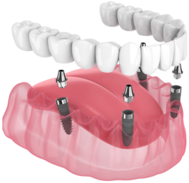 Восстановление всех зубов на 4 имплантах Osstem