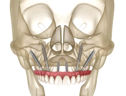 Скуловая имплантация зубов Zygoma