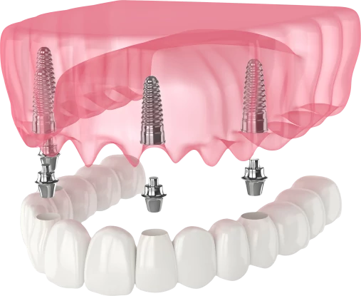 Полная имплантация всех зубов