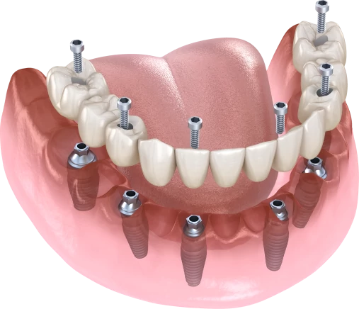 Имплантация зубов All-on-6 — «Всё на 6 имплантах»