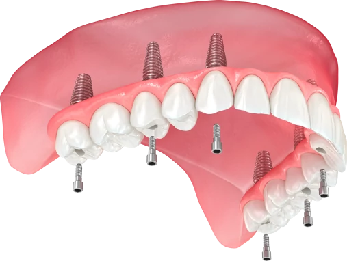 Технология Straumann Pro Arch