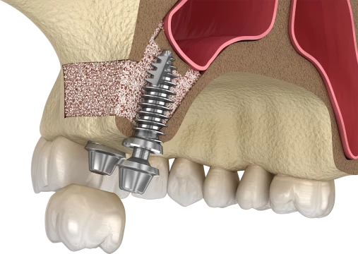 Имплантация совместно с синус-лифтингом