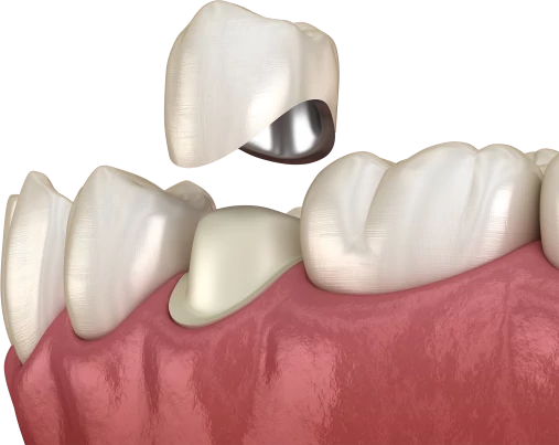 Металлокерамические коронки на зубы
