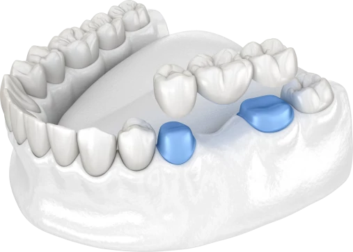 Зубной мост — виды, этапы установки и цены