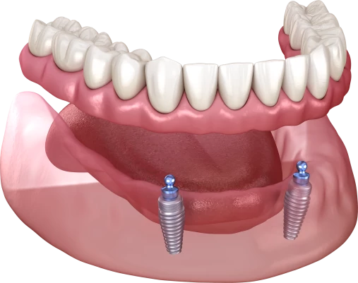 Съёмный протез с опорой на имплантах