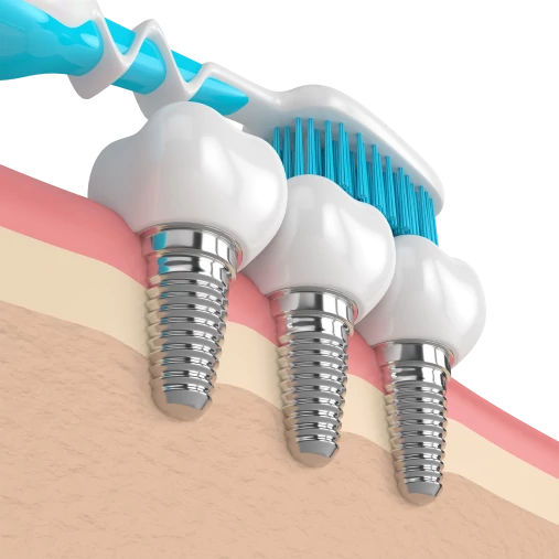 Уход за полостью рта после имплантации зубов