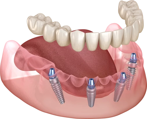 Всё на 4 имплантах — имплантация зубов All-on-4
