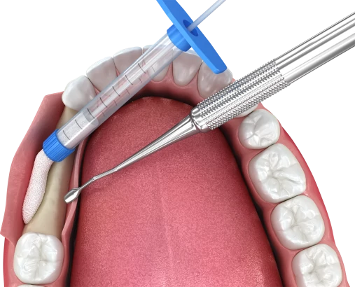 Наращивание костной ткани при имплантации зубов