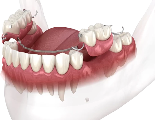 Частичный съемный зубной протез нового поколения