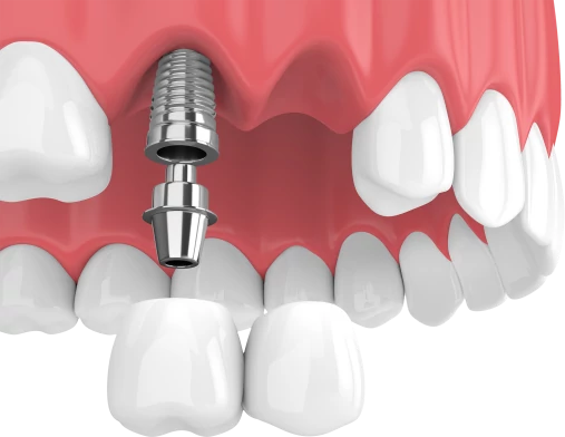 Протезирование 2 зубов на имплантах