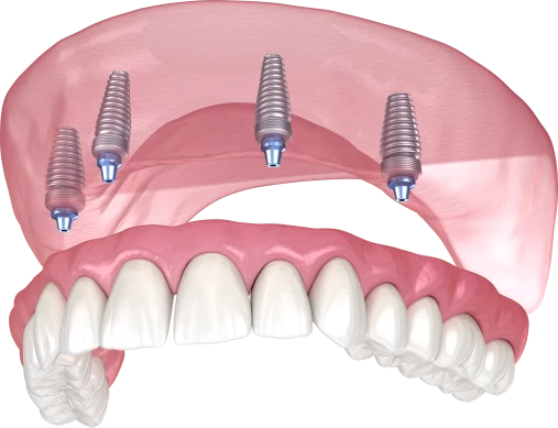 Протезирование верхних зубов на имплантах