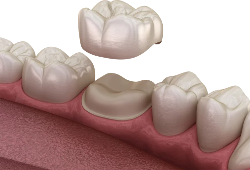 Реставрация жевательных зубов коронками