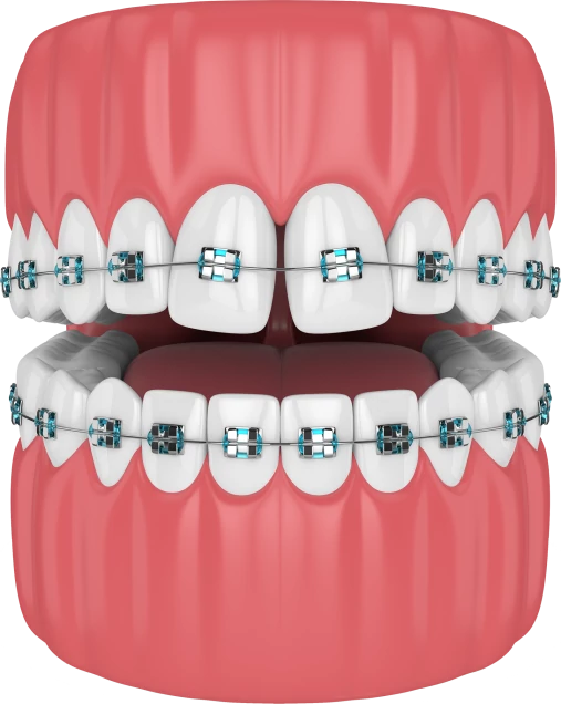 Ортодонтическое лечение брекетами