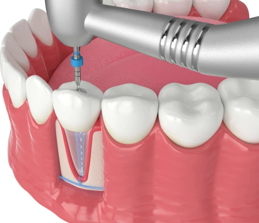 Лечение каналов зубов