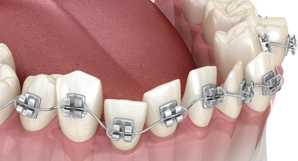 Как проводится лечение на металлических брекетов