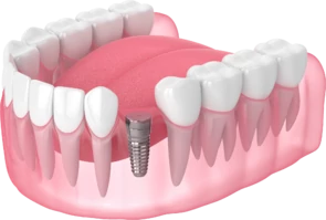 Имплантация зубов