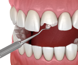 Эстетическая реставрация передних зубов