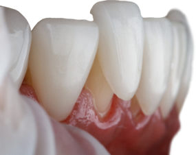 Керамические виниры