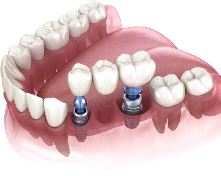 Зубной мост на имплантах