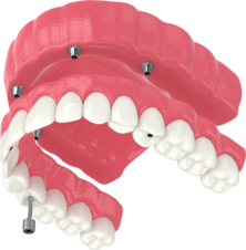 Протезирование на имплантах