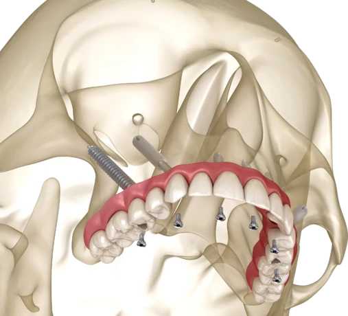 Птеригоидная имплантация