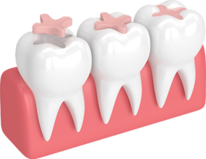 Керамическая вкладка